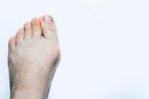 What Causes Bunion Pain and How to Relieve It Naturally