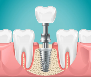 Advantages of Zirconia Teeth Implants Over Other Materials