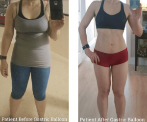 What You Need to Know About Gastric Balloon Procedures in Dubai