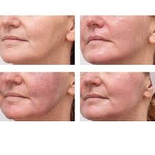 Elevate Your Skin Health with LaseMD Ultra Fractional Laser in Scottsdale