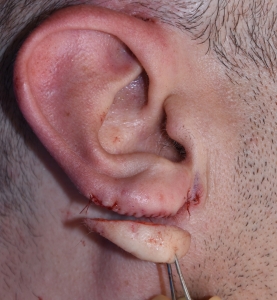 Your Journey to Perfect Earlobes Starts in Riyadh