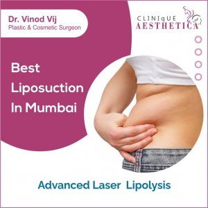 Effortless Weight Loss with Advanced Laser Lipolysis: Dr. Vinod Vij's Solution for Those with No Time for the Gym, Running, or Dieting