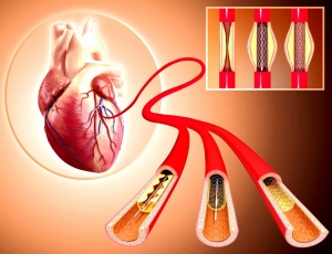 Understanding Angioplasty Cost in Delhi: Finding the Right Cardiologist for Your Needs