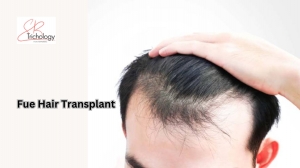 Ultimate Guide to Hair Transplant: How It Works and What to Expect