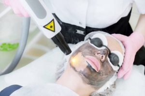 Achieve Radiant Skin: The Comprehensive Guide to Laser Carbon Peel