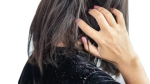 Dandruff