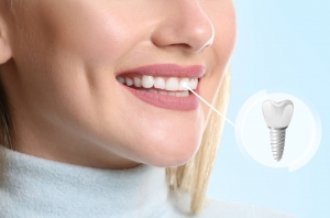 Where to Get Quality Dental Implants and Invisalign Near You