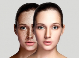 Erase Hyperpigmentation: The Best Treatments Available in Dubai