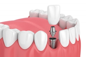 Dental Implants: Revolutionizing Oral Health