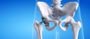 Revitalize Your Mobility: A Comprehensive Guide to Hip Replacement Surgery in Kolkata