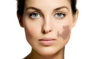 How to Prepare for Birthmark Removal Surgery