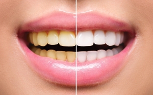 The Ultimate Guide to Teeth Whitening Achieve a Brighter Smile