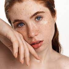 Freckles Under the Dubai Sun: A Unique Skin Journey