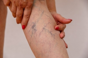 Tips for Choosing the Best Varicose Veins Specialist