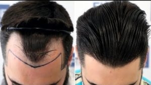 The Journey to a Thicker Head of Hair: Hair Transplants Explained