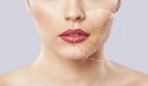 Advanced Acne Treatments in Abu Dhabi