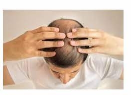 Hair Loss Solutions in Dubai: Unveiling the Ethical and Islamic Considerations of Transplants