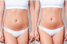 Pros and Cons of Lipolytic Injections for Fat Reduction