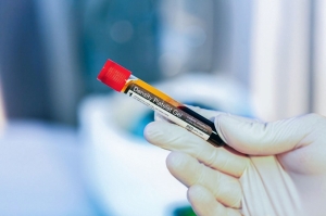 Enhance PRP Treatments with Premium PRP Separation Tubes | JuvaPRP