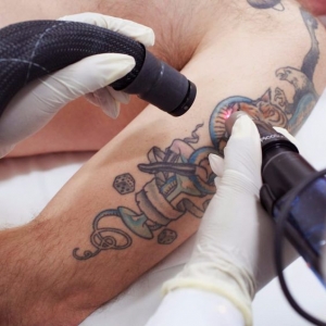 Is Laser Tattoo Removal Safe? Insights from Dubai Experts