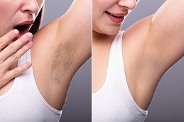 Electrolysis vs. Laser Hair Removal: Which is Better?