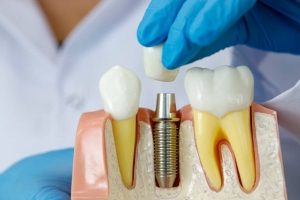 The ins and outs of dental implants!