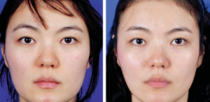 Face Sculpt Skin Treatment in London