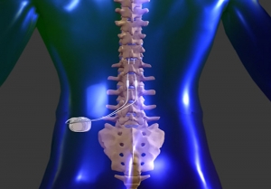 Spine Bone Stimulators Market Share, Trend, Segmentation and Forecast to 2031