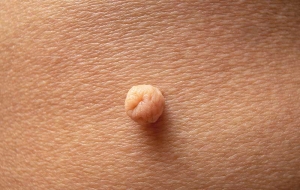 Discover the Best Skin Tag Removal Treatment for Your Needs