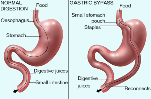 Lose Weight Without Surgery: Gastric Balloon in Riyadh