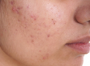 Why Choose Professional Acne Treatments in Abu Dhabi?