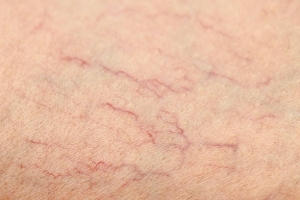 Advanced techniques for Spider Vein Treatment in Abu Dhabi