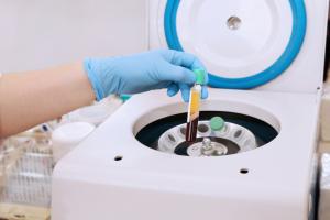 Prp Hair Treatment in Chennai