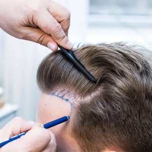 The Science Behind Hair Transplants Dubai Clinics Offer Advanced Techniques