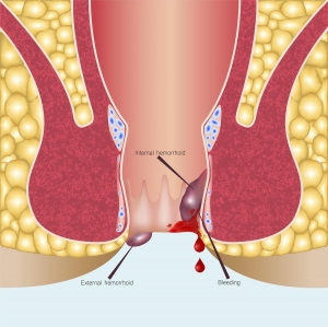 Hemorrhoids Market Share 2024 | Forecast till 2034