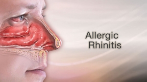 Allergic Rhinitis Market Size, Trends And Forecast To 2034