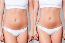 Dubai Injectable Body Sculpting Treatments Fat-Dissolving Options for a Defined Physique