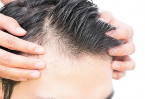 Comprehensive Hair Restoration in Dubai