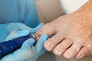 What is Hammer toe Surgery? and How Much Time Time Recover