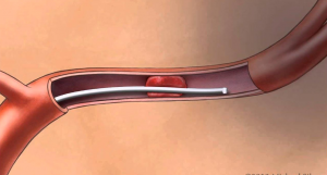 Mechanical Thrombectomy Devices Market Size, Share, Company Profiles and Trends Forecast 2030 