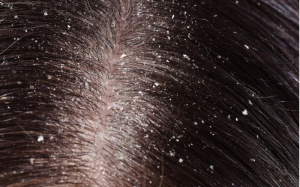 Ayurvedic Bliss: Ditch Dandruff and Relieve Scalp Itch