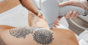 Tattoo Removal Journey: Before and After in Dubai