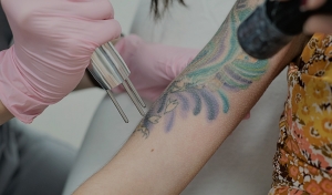 Laser Tattoo Removal for Cover-Up Tattoos in Dubai