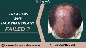 5 Reasons Why Hair Transplant Failed ? Facts You Must Know