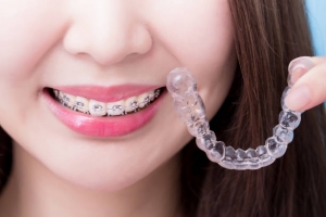 Affordable Orthodontic Options So That Your Dream Smile Does Not Have to Break the Bank