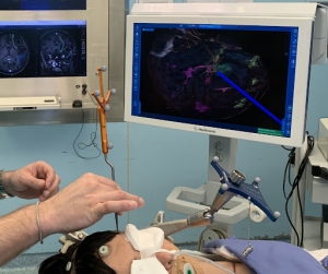 Neuro-navigation Systems: Revolutionizing Brain Surgeries