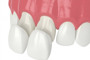 10 Questions to Ask Your Dentist About Veneers