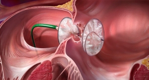 Patent Foramen Ovale (PFO) Closure Devices Industry See Steady Growth