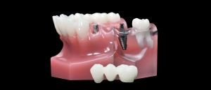 Dental 3D Printing Market Share, Trend, Segmentation and Forecast to 2031