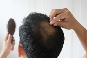 Understanding Hair Transplant Costs in Dubai